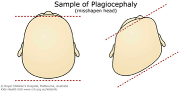 Plagiocephaly-sample